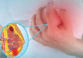Breast lump illustration for RACZOMAX