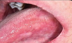 Oral health image for RACZOMAX OSMF product