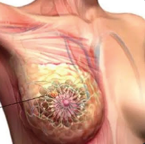 RACZOMAX-PLUS breast fibroadenoma illustration