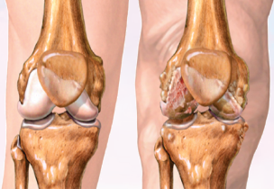 Osteoarthritis knee illustration
