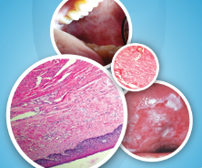 RACZOMAX-PLUS OSMF oral health illustration