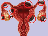 Uterine fibroids and endometriosis illustration for RACZOMAX